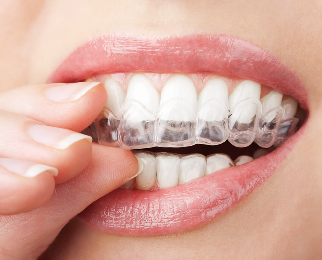 Invisalign Zahnschienen Kiel